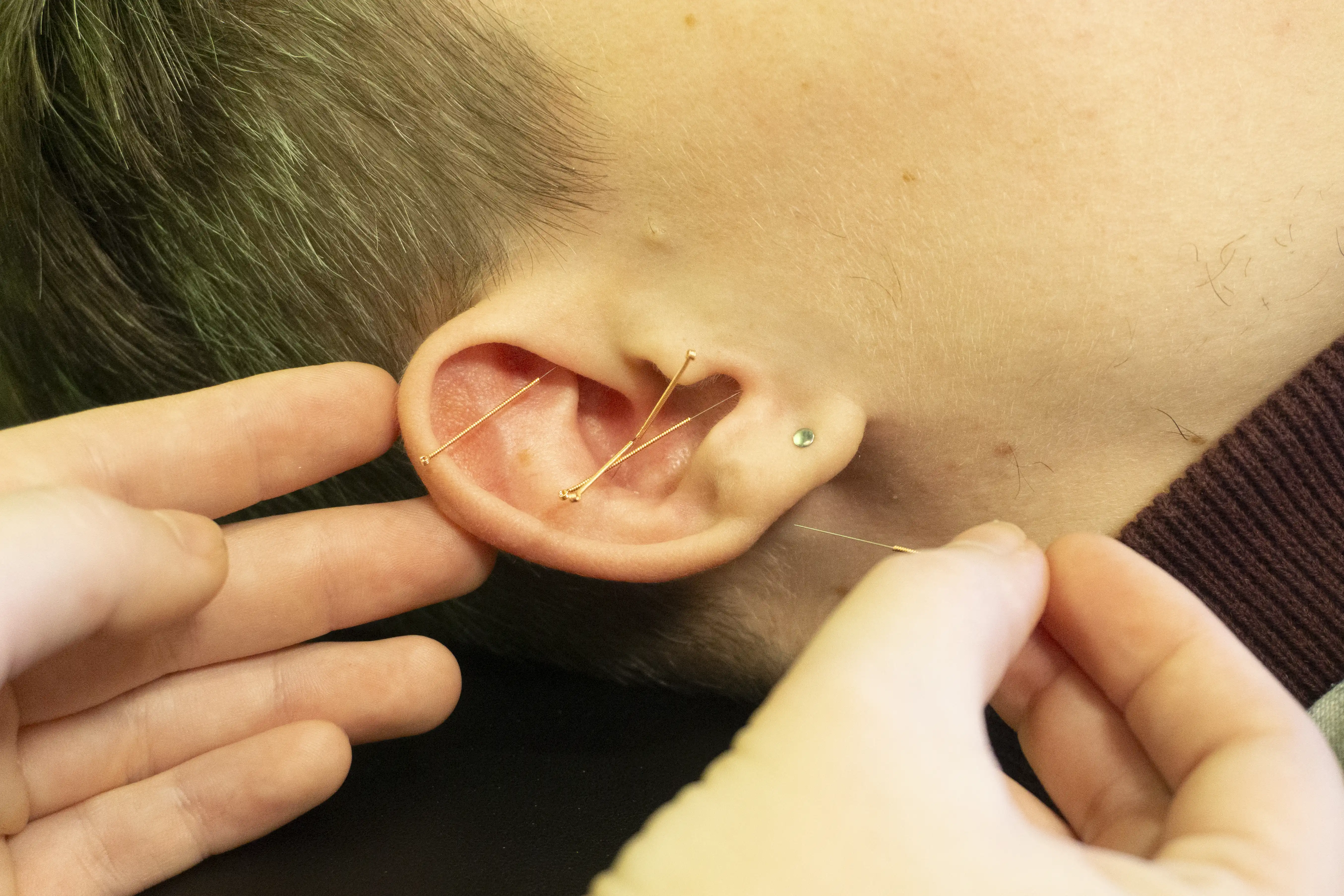 ear_acupuncture