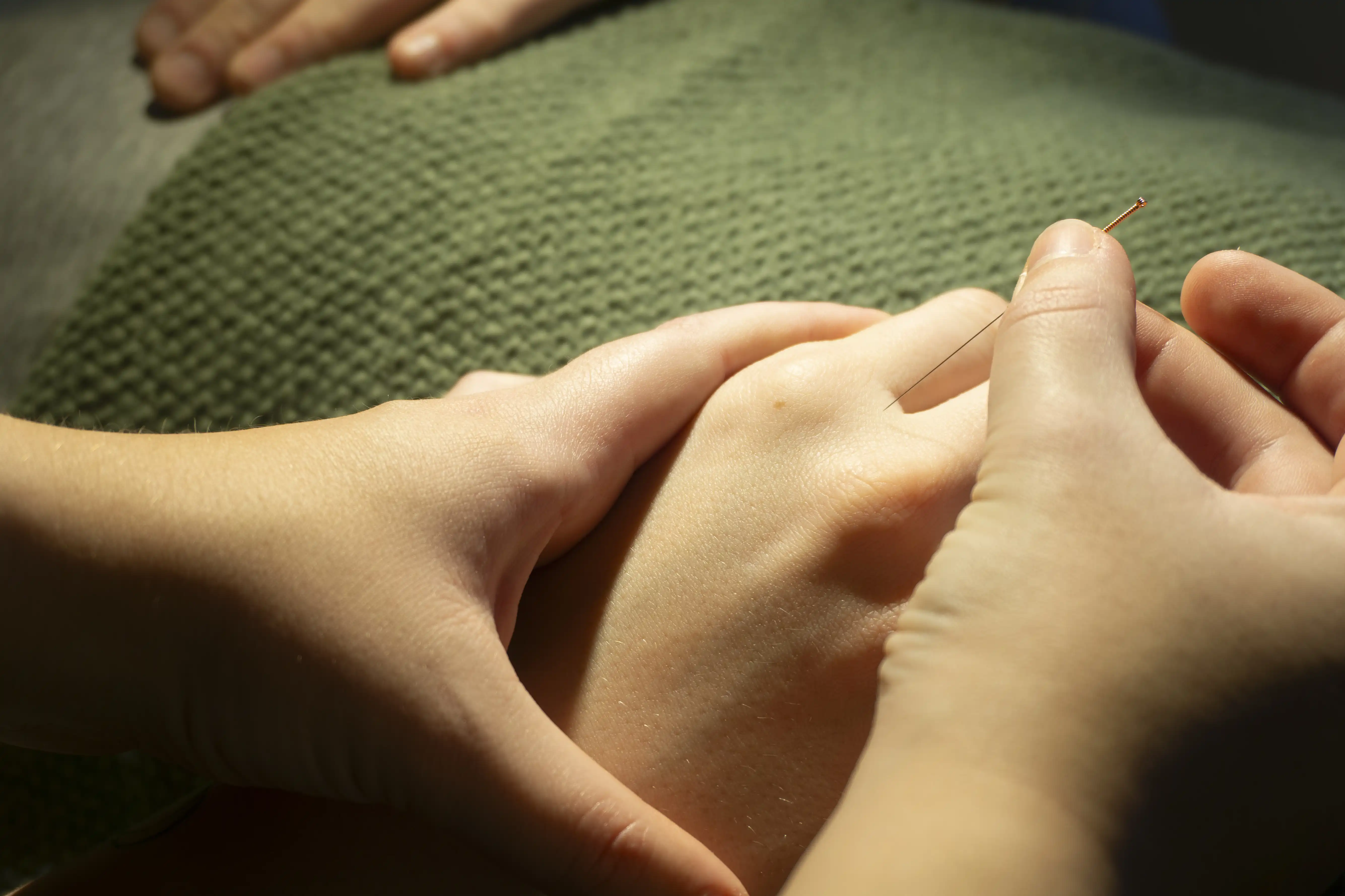hand_acupuncture