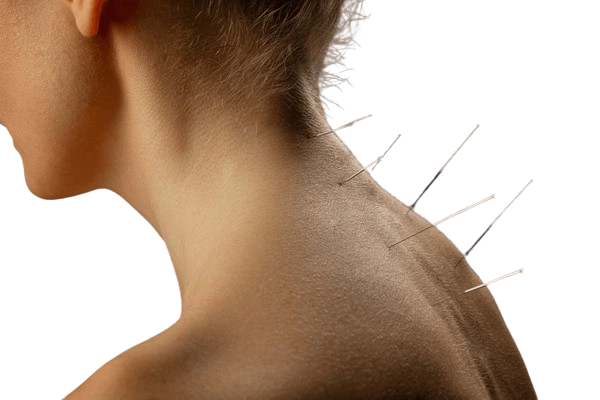 neck_acupuncture