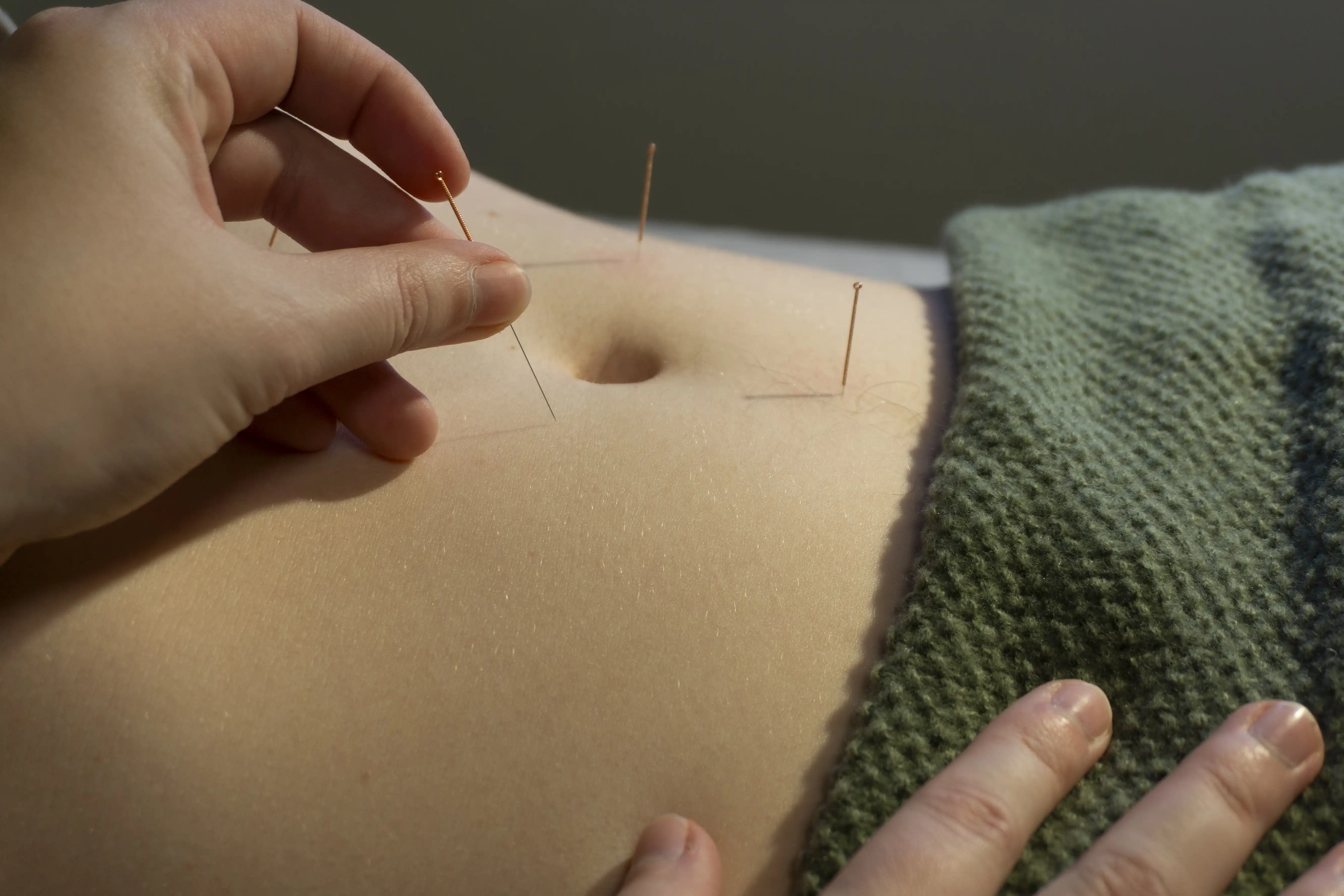 stomach_acupuncture